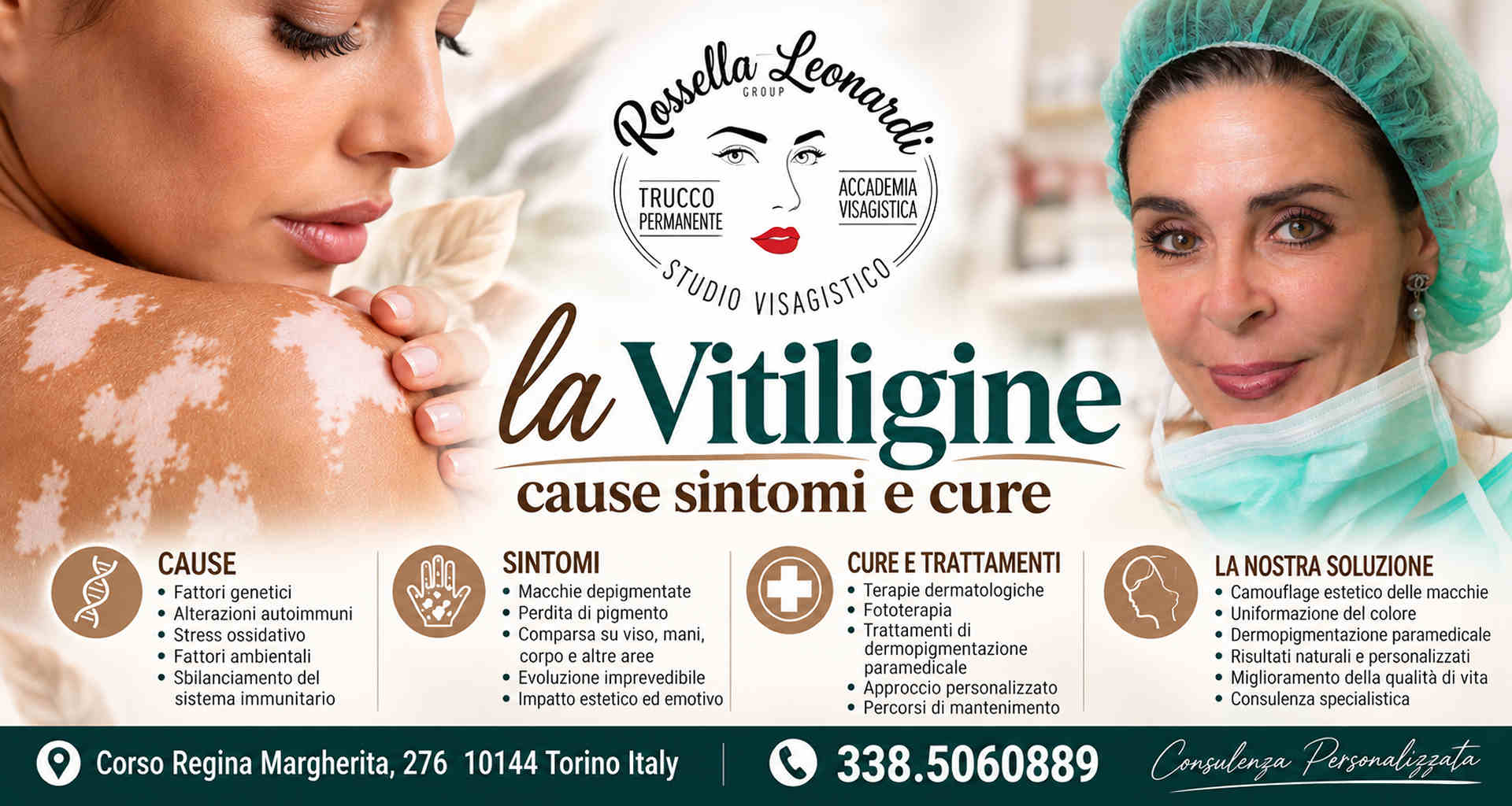 Vitiligine Vitiligine